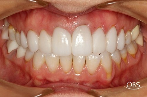 Angela's Case — after treatment at Oak Brook Smiles