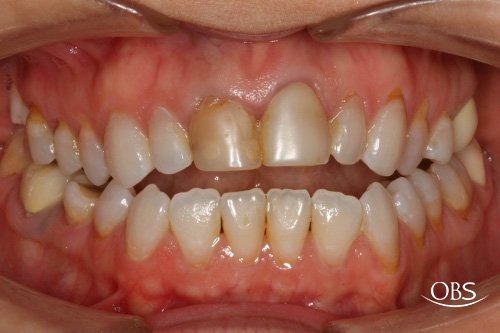 Angela's Case — before treatment at Oak Brook Smiles