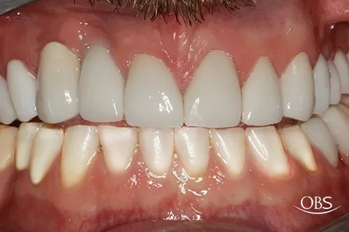 Gary's Case — after treatment at Oak Brook Smiles