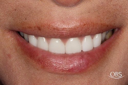 Amanda's Case — after treatment at Oak Brook Smiles