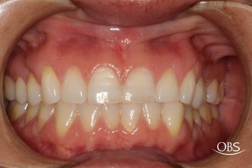 Amanda's Case — before treatment at Oak Brook Smiles