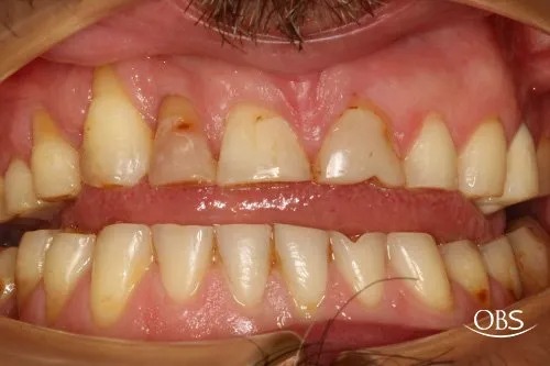 Gary's Case — before treatment at Oak Brook Smiles